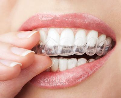 invisalign boise