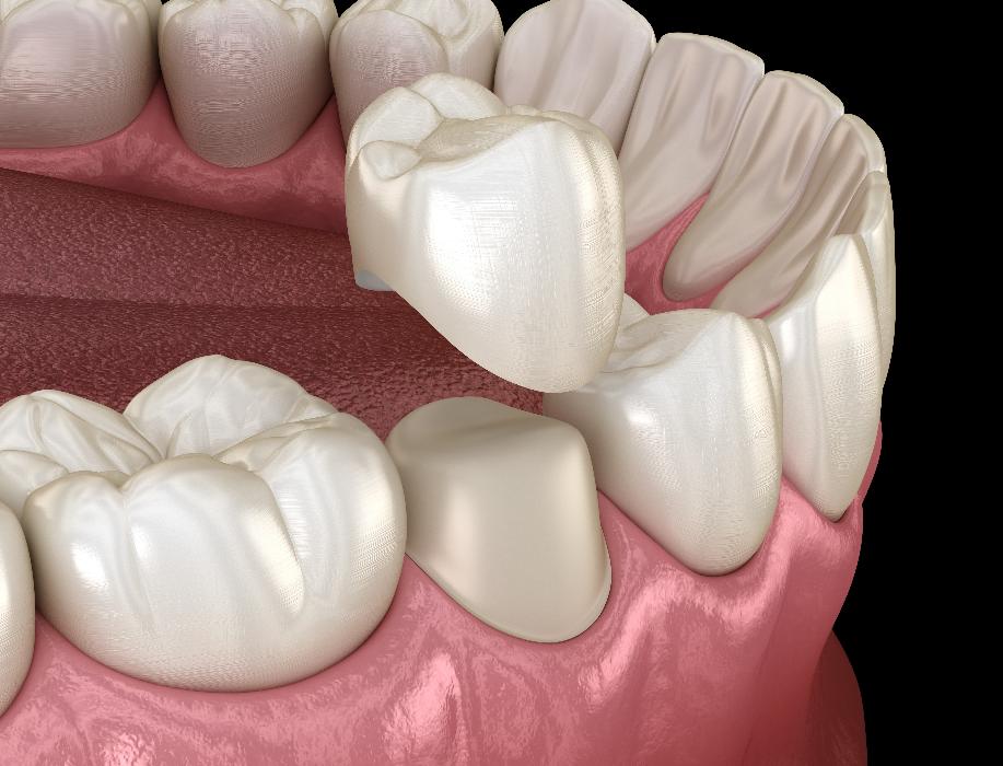 dental crowns boise | image of dental crown