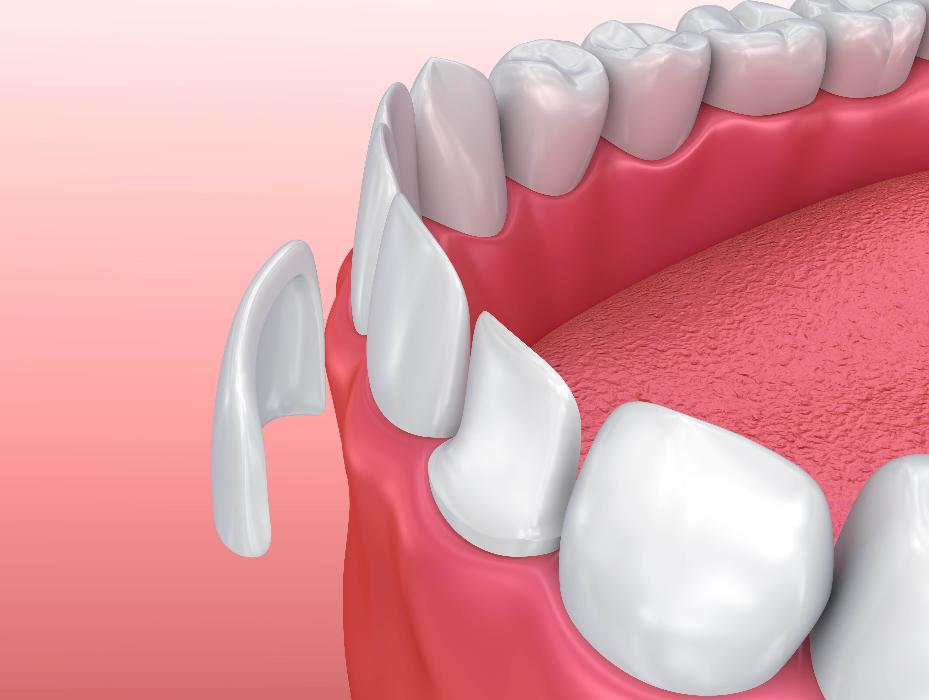 porcelain veneers boise