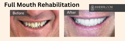 full mouth reconstruction boise | before and after