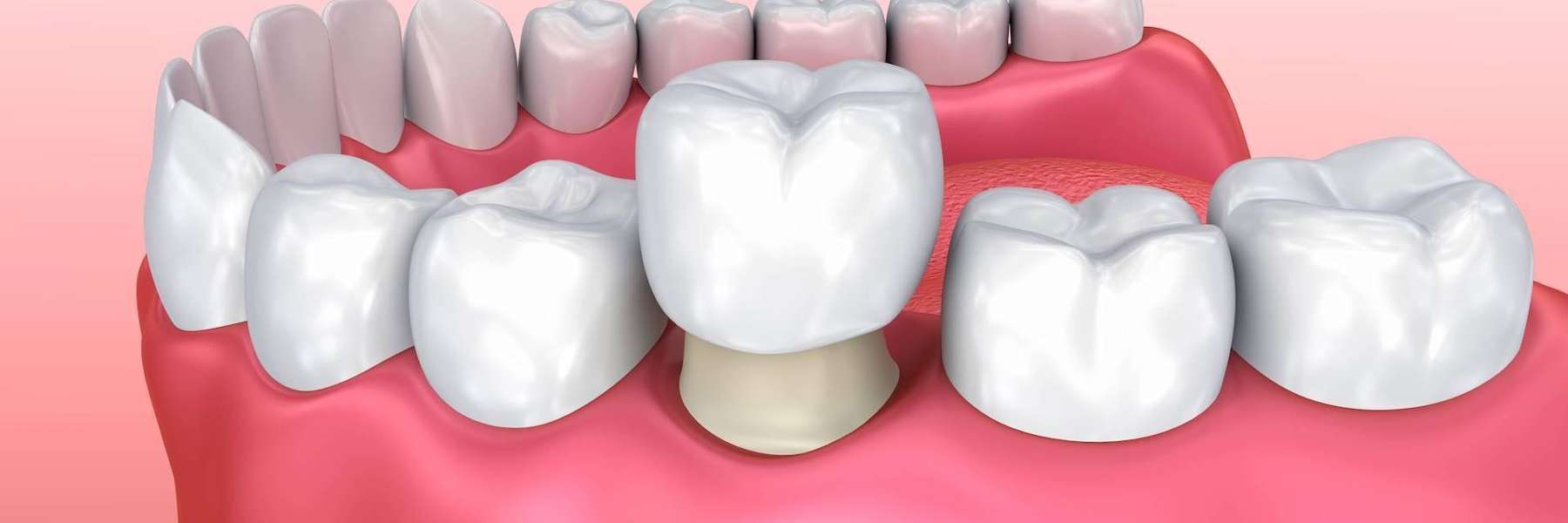teeth whitening Boise, ID
