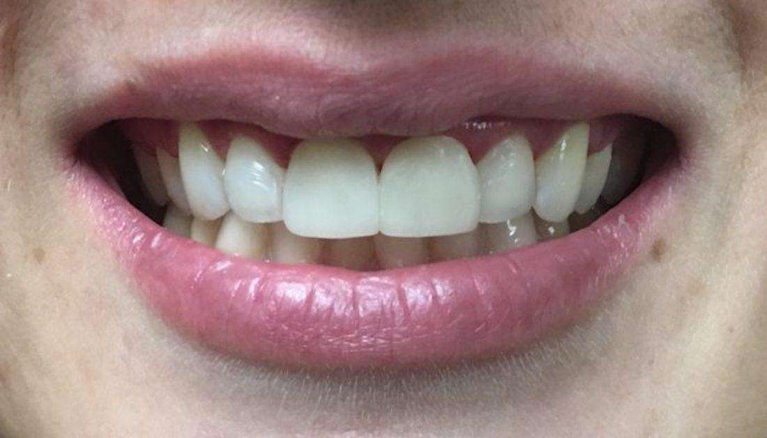 Cosmetic Bonding results in Boise