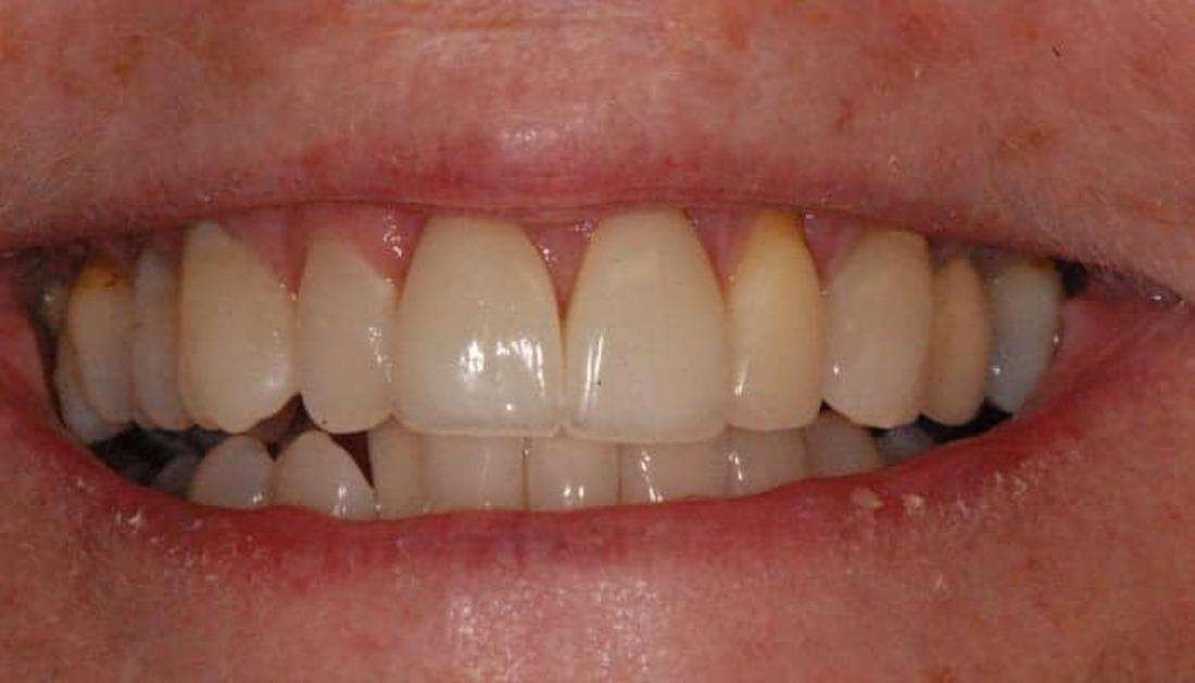 after photo of patient with porcelain veneers on front teeth in boise