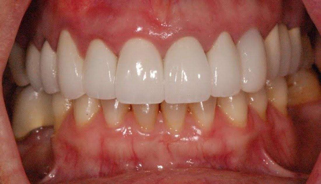 After photo of patient with upper reconstruction work on boise id