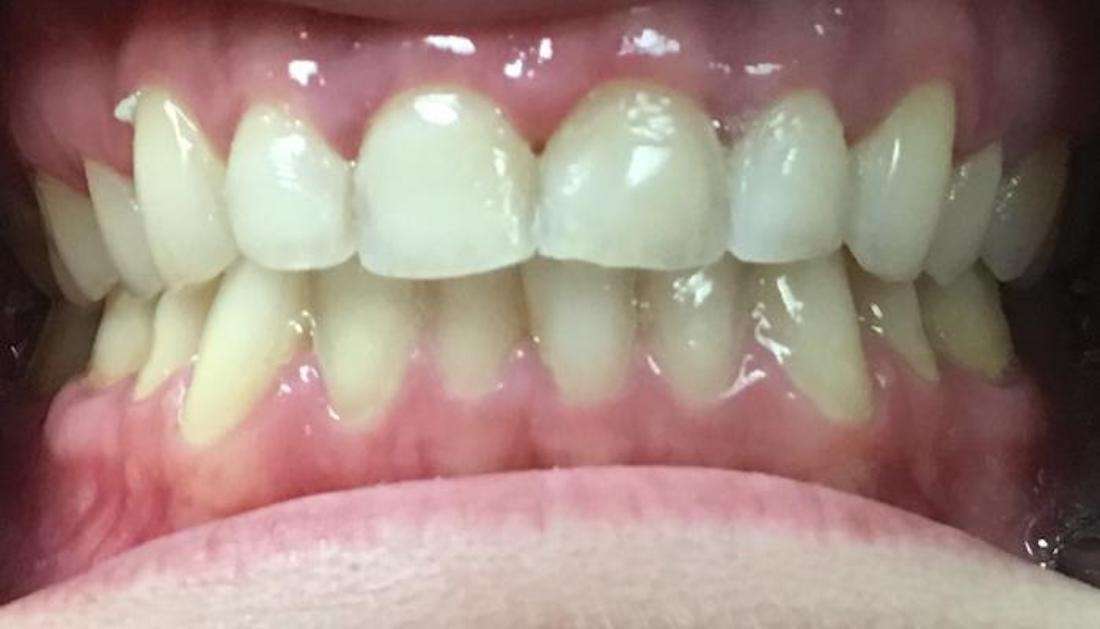 Teeth before cosmetic bonding in Boise