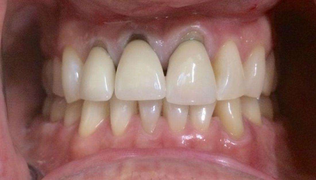 Before Old Dental Crowns Before in Boise ID