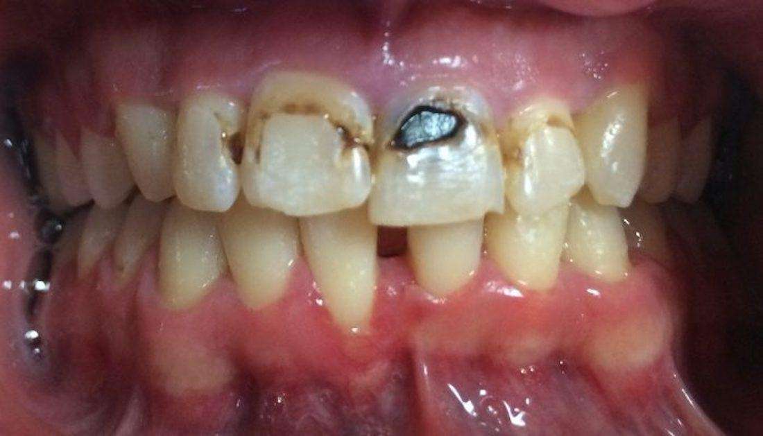 Before of Cosmetic Dental Bonding in Boise, ID