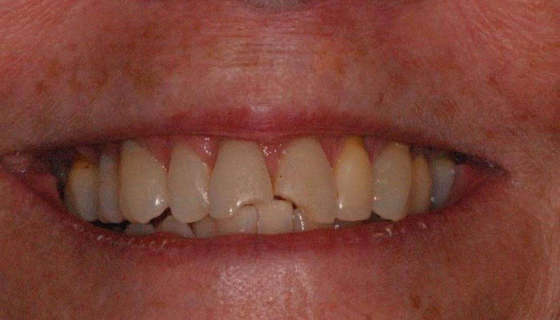 patient before getting dental veneers in boise