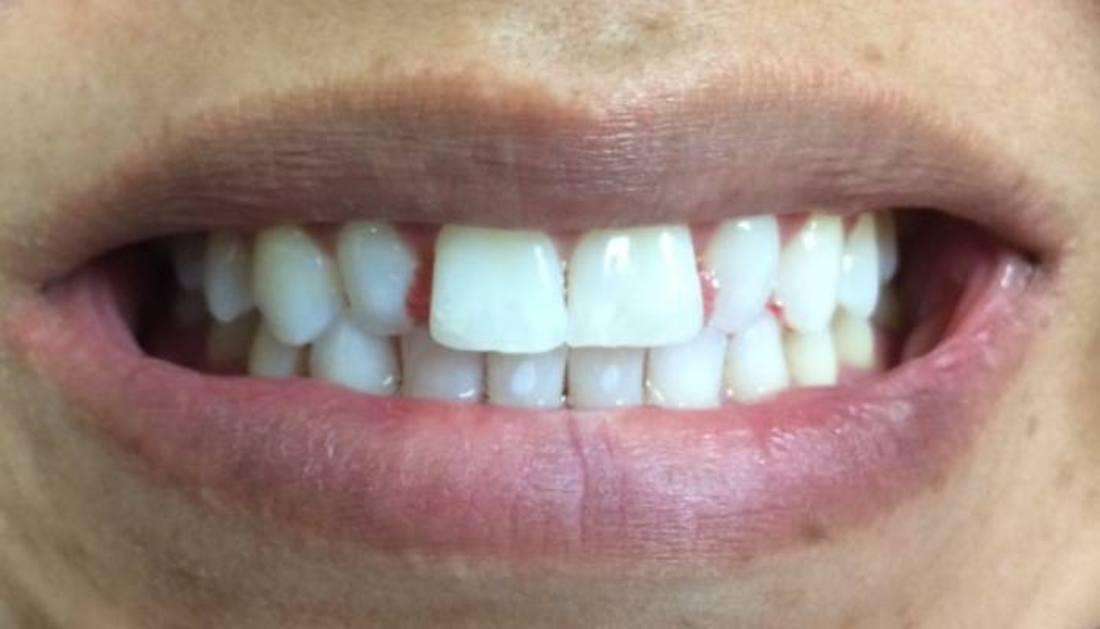 patient before new veneers on front teeth in Boise