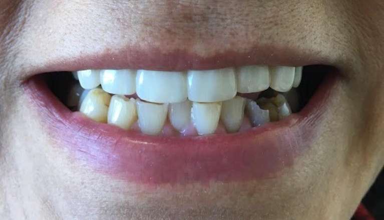 after photo of patient with new dental bridge in Boise ID