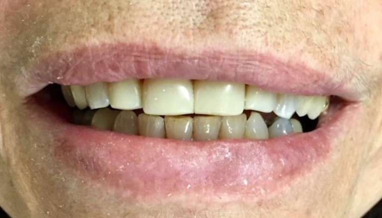 after photos of cosmetic bonding in boise id