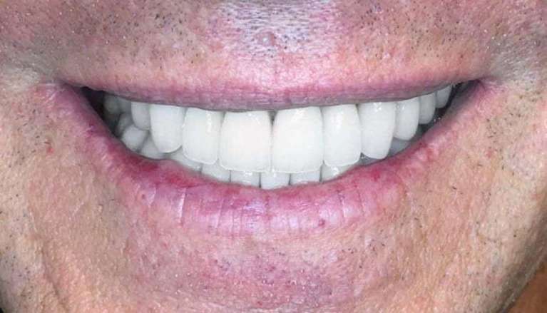 patient after full mouth rehabilitation in boise id