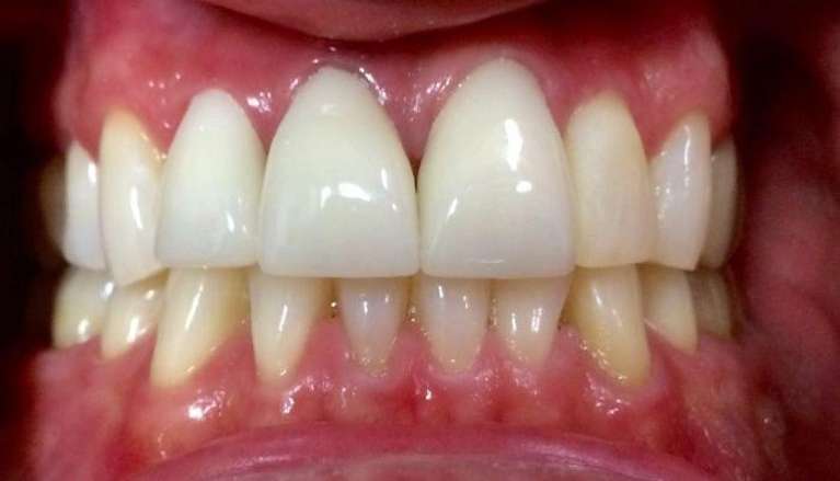 After New Dental Crowns in Boise ID