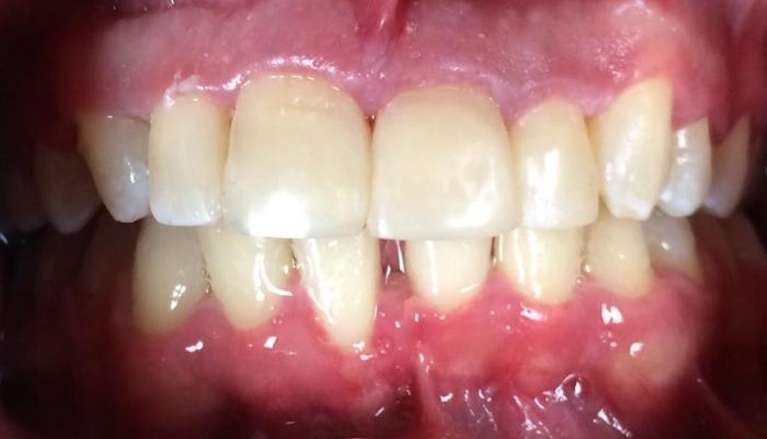 After photo of Cosmetic Dental Bonding in Boise, ID