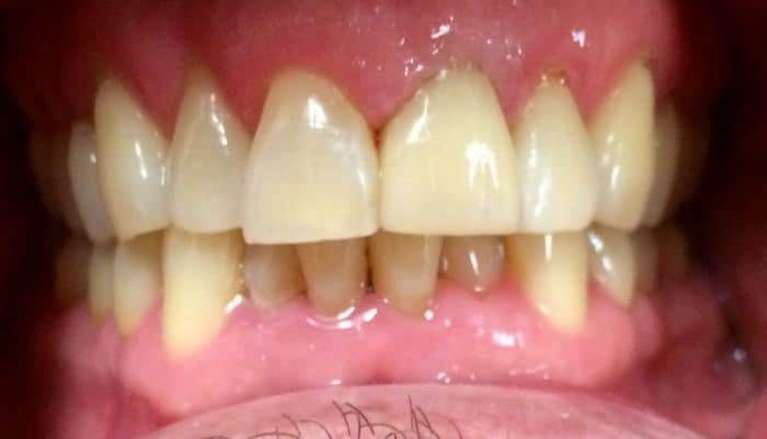 After tooth with new dental crown in Boise ID
