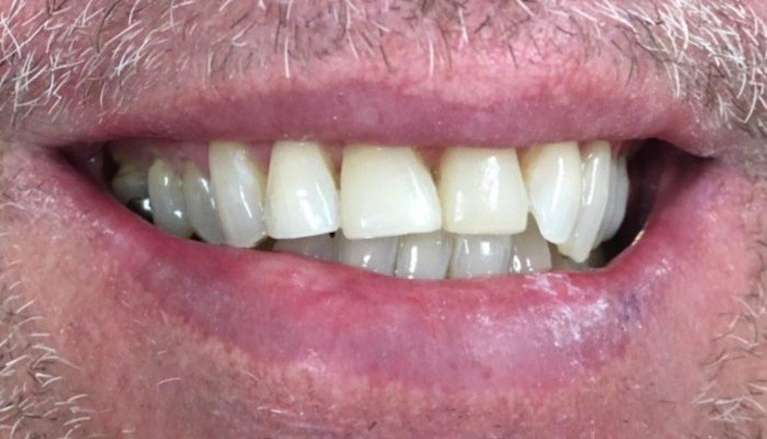 patient with new cosmetic dental bonding on front teeth in boise