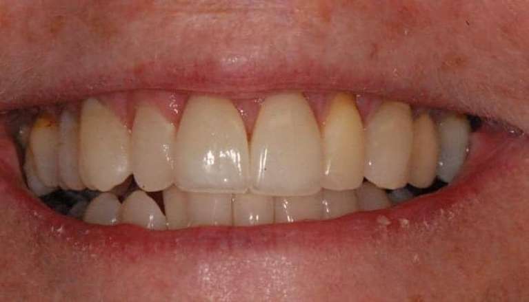after photo of patient with porcelain veneers on front teeth in boise