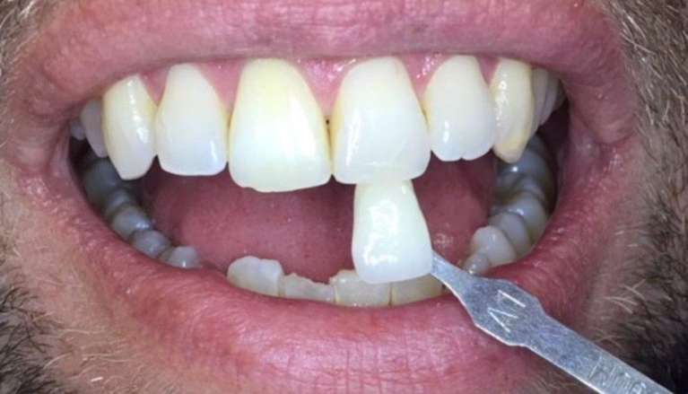 patient after getting tooth whitened in boise id