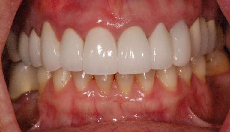 After photo of patient with upper reconstruction work on boise id