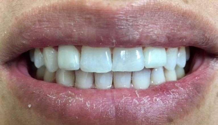 patient with new veneers on upper laterals in boise
