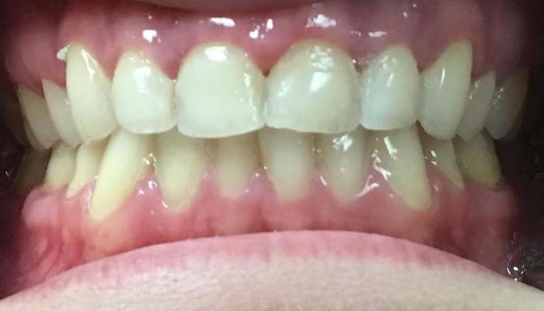 Cosmetic-Bonding-Before-After-in-Boise-Before-Image