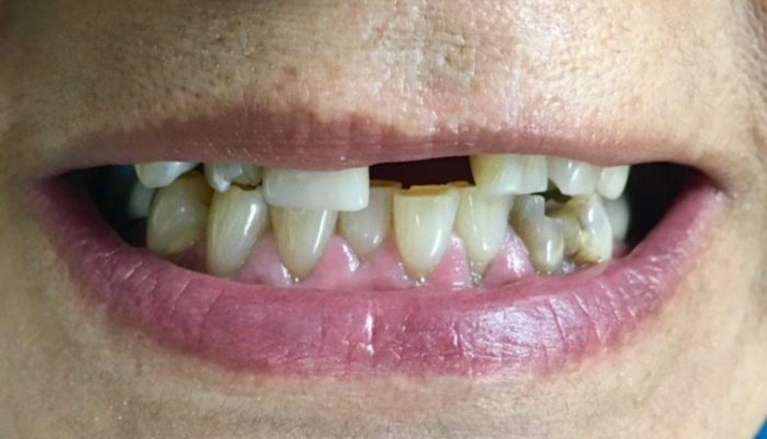 Patient before new dental bridge in Boise ID