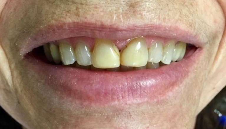 Patient case before cosmetic bonding in boise id