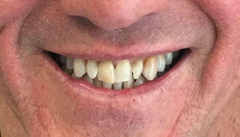 Patient before full mouth rehabilitation in boise