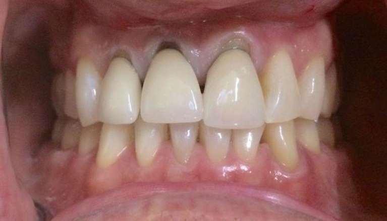 Before Old Dental Crowns Before in Boise ID