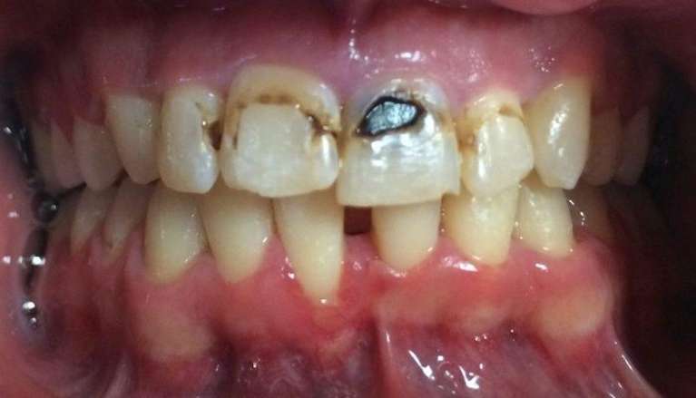 Before of Cosmetic Dental Bonding in Boise, ID