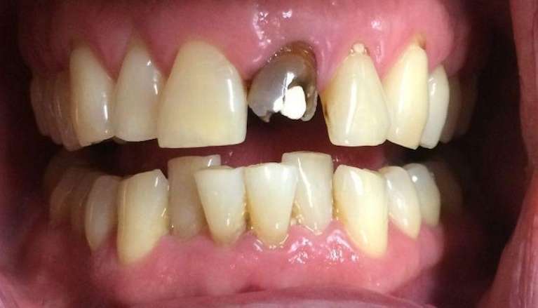 Before tooth in need of new dental crown in Boise
