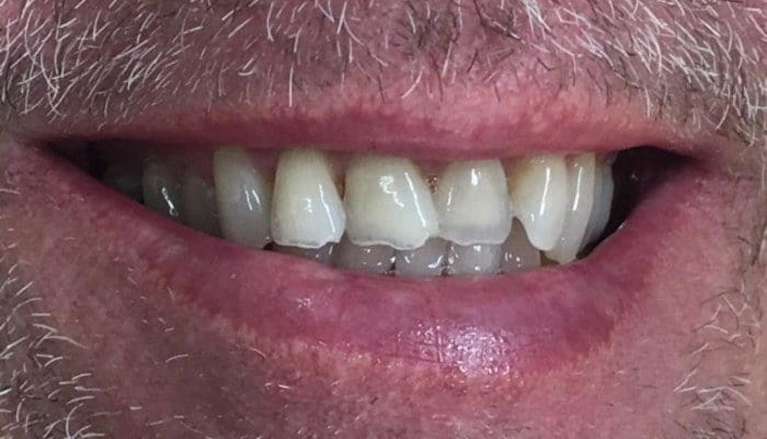 Patient before cosmetic dental bonding in boise id