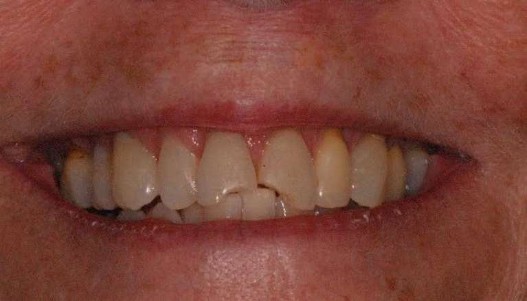 patient before getting dental veneers in boise