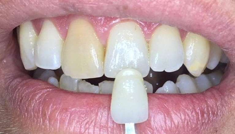 before patient needing teeth whitening in boise id