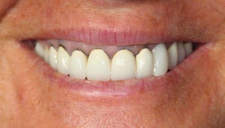 Before patient in need of new cosmetic work Boise