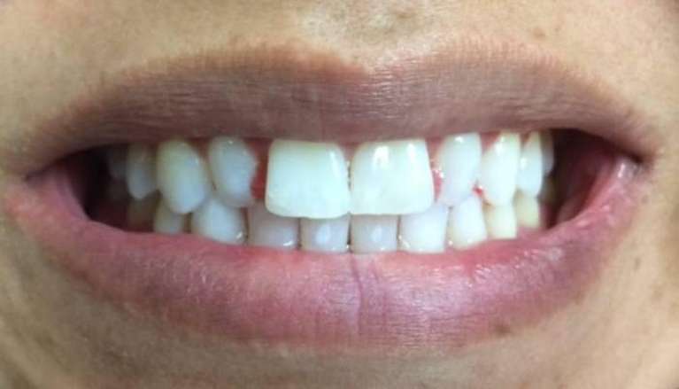 patient before new veneers on front teeth in Boise